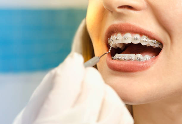 Closeup shot of dental braces checkup