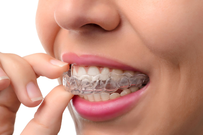 Closeup shot of Invisalign removal