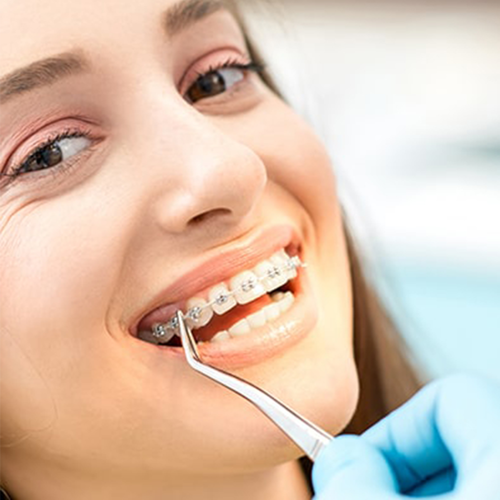 Closeup shot of braces of a woman